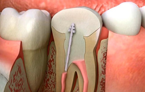 Root Canals